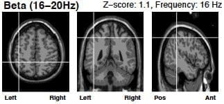 beta wave brain scan after neurofeedback